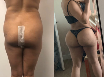 my ass before and after my first bbl! i can't wait to get another bbl to keep growing!