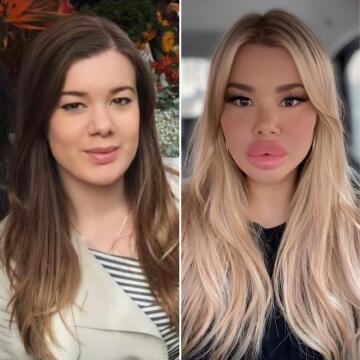 before after lip fillers