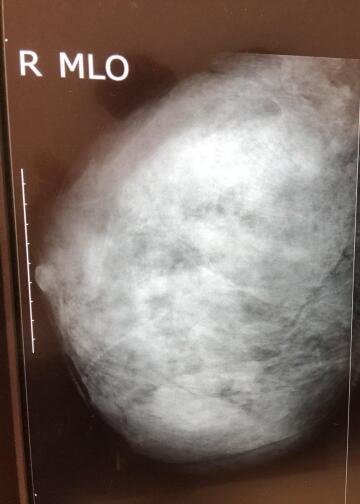 an official mammogram (x-ray of her titty)