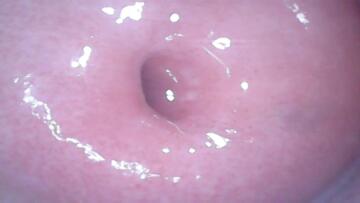 pristine 38yo cervix anyone?