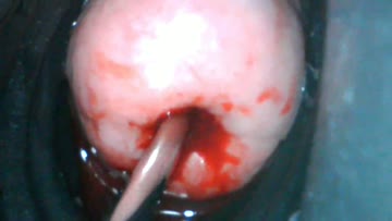 want an extreme close-up? 😂 endoscope view of sounding my menstruating cervix
