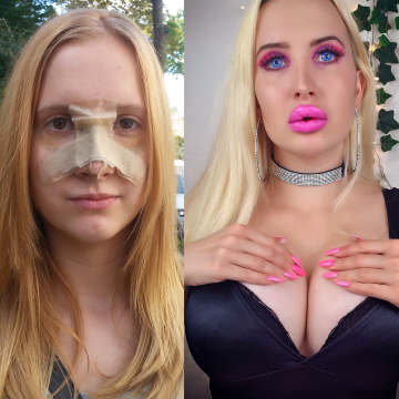 me after getting my nose job vs now 💗 more fillers on 16th nov. - the journey continues 🥰